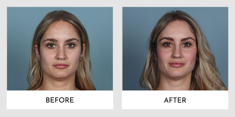 Forever Young Bbl Laser Treatment Before and After | Aesthetic MdR