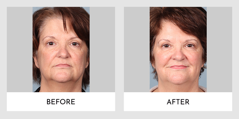 Forever Young Bbl Laser Treatment Before and After | Aesthetic MdR