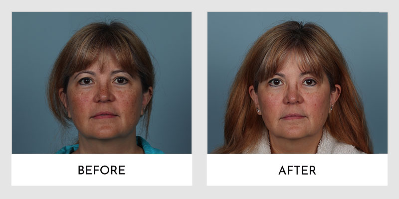 Forever Young Bbl Laser Treatment Before and After | Aesthetic MdR