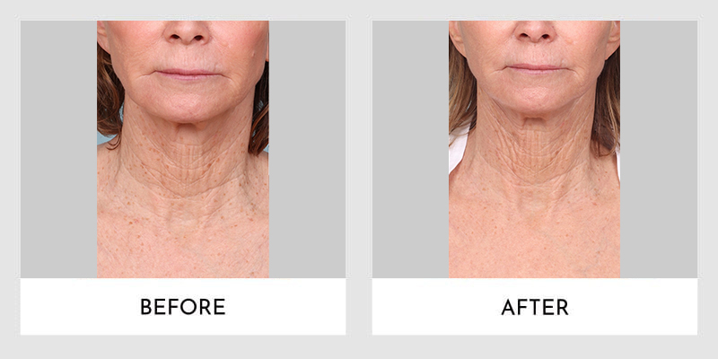 Forever Young Bbl Laser Treatment Before and After | Aesthetic MdR