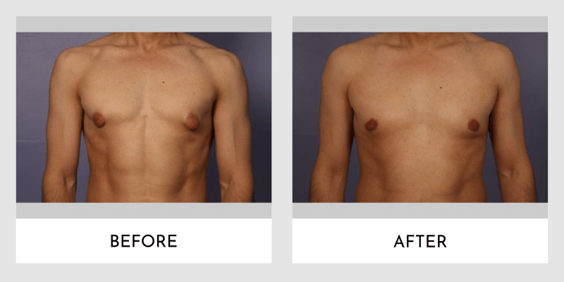 Gynecomastia Before and After | Aesthetic MdR