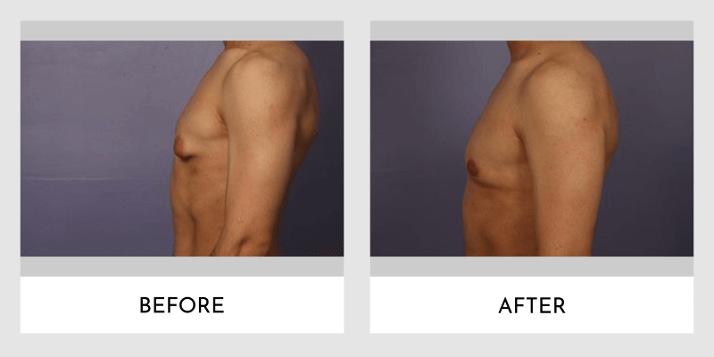 Gynecomastia Before and After | Aesthetic MdR