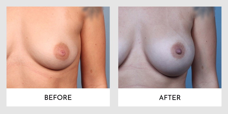 Inverted Nipple Before and After | Aesthetic MdR