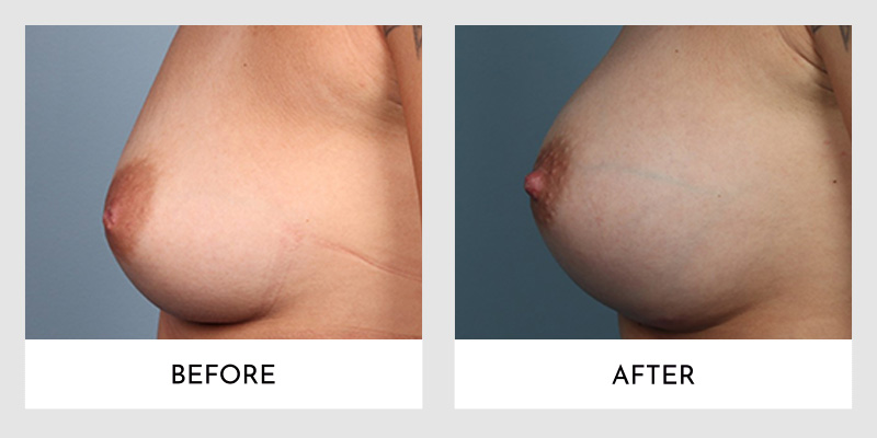 Inverted Nipple Before and After | Aesthetic MdR