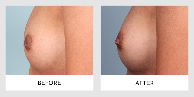 Inverted Nipple Before and After | Aesthetic MdR