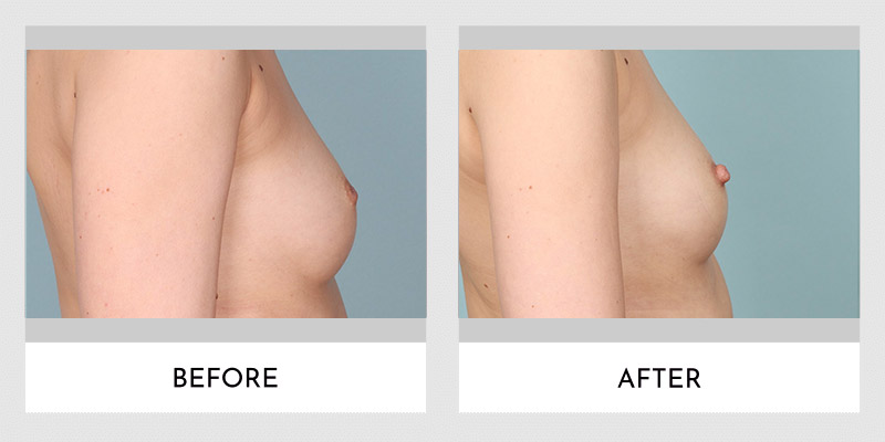 Inverted Nipple Before and After | Aesthetic MdR