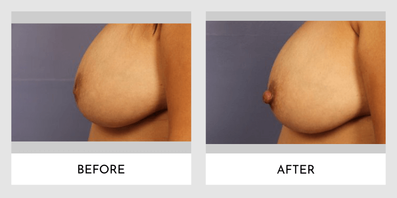 Inverted Nipple Before and After | Aesthetic MdR