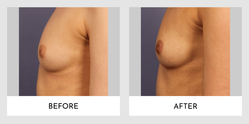 Inverted Nipple Before and After | Aesthetic MdR