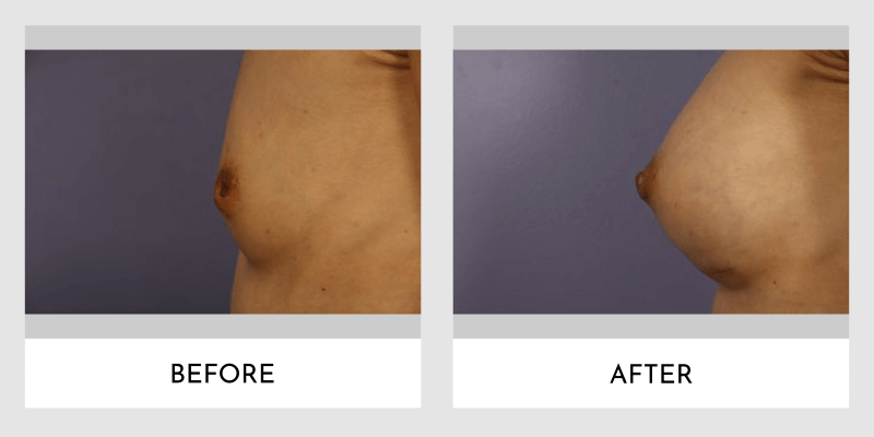 Inverted Nipple Before and After | Aesthetic MdR