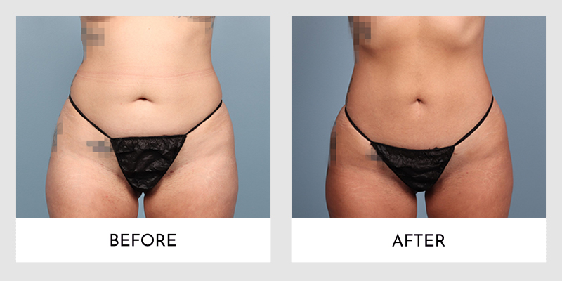 Liposuction Before and After | Aesthetic MdR