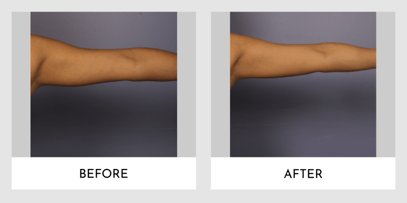 Liposuction Before and After | Aesthetic MdR