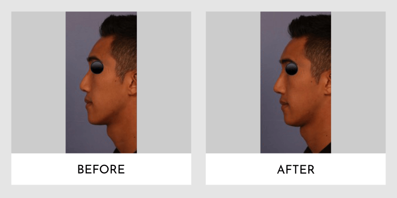 Male Non Surgical Rhinoplasty Before and After | Aesthetic MdR