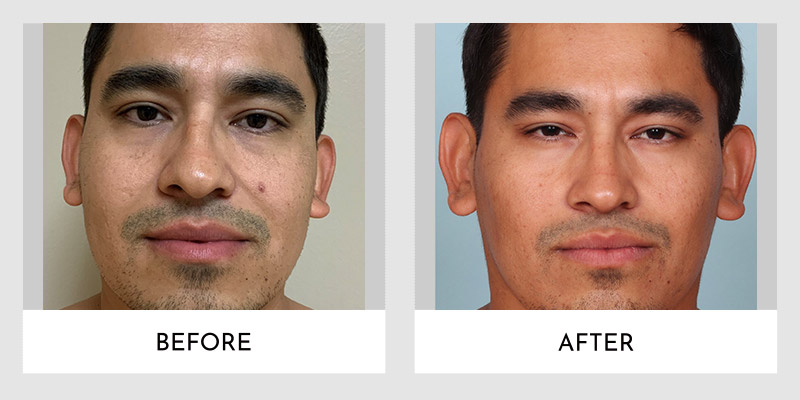 Male Rhinoplasty Before and After | Aesthetic MdR