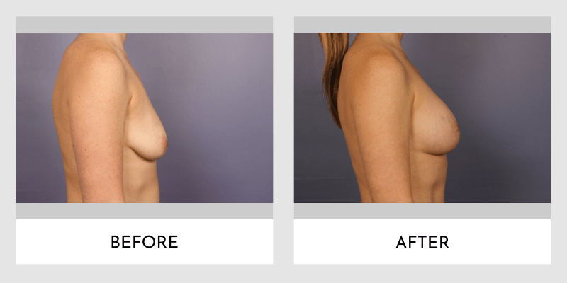 Mastopexy With Implant Before and After | Aesthetic MdR