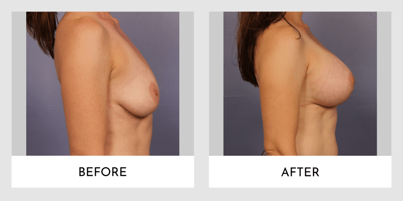 Mastopexy With Implant Before and After | Aesthetic MdR