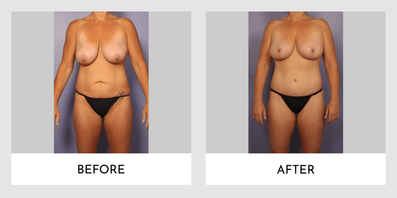 Mommy Makeover Before and After | Aesthetic MdR