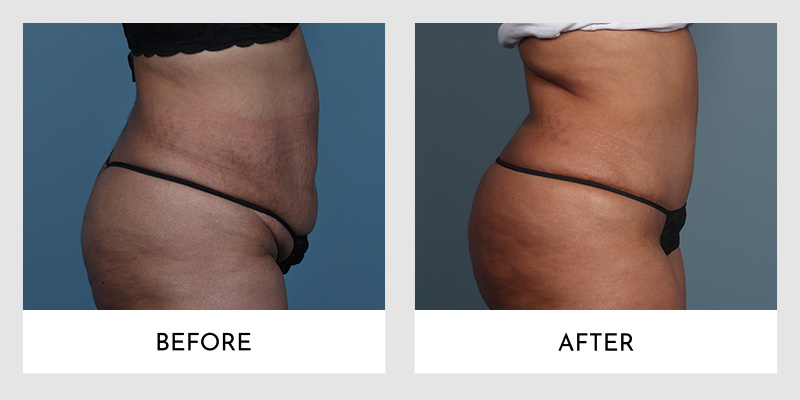No Drain Tummy Tuck Before and After | Aesthetic MdR