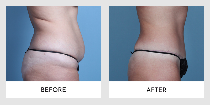 No Drain Tummy Tuck Before and After | Aesthetic MdR