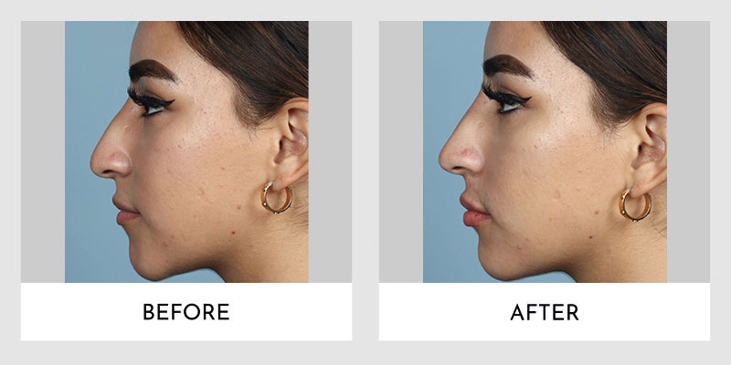Non Surgical Rhinoplasty Before and After | Aesthetic MdR