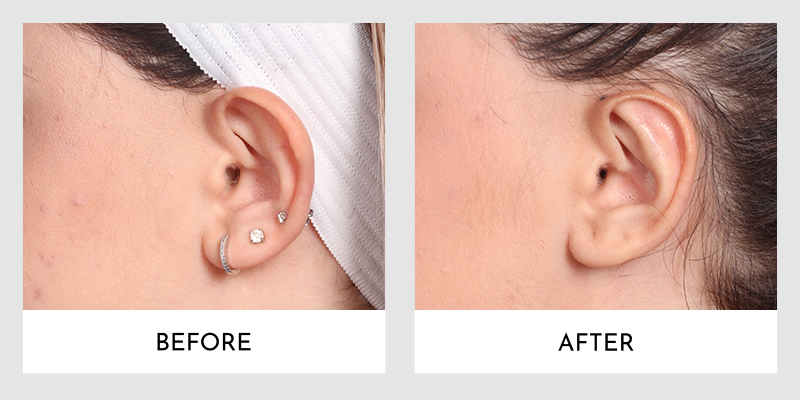 Otoplasty Before and After | Aesthetic MdR