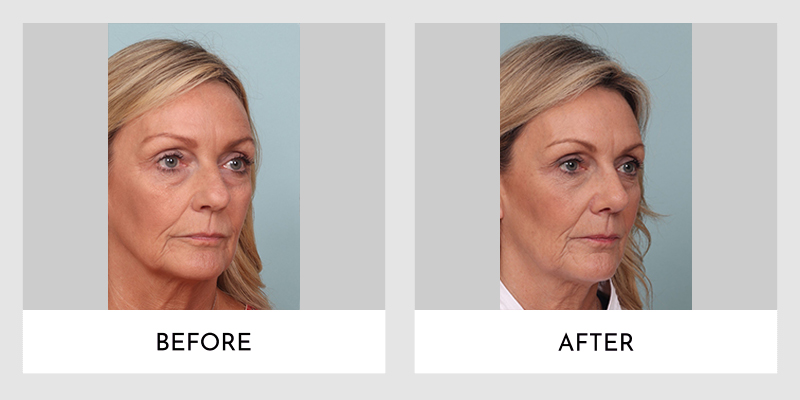 Rhinoplasty Before and After | Aesthetic MdR