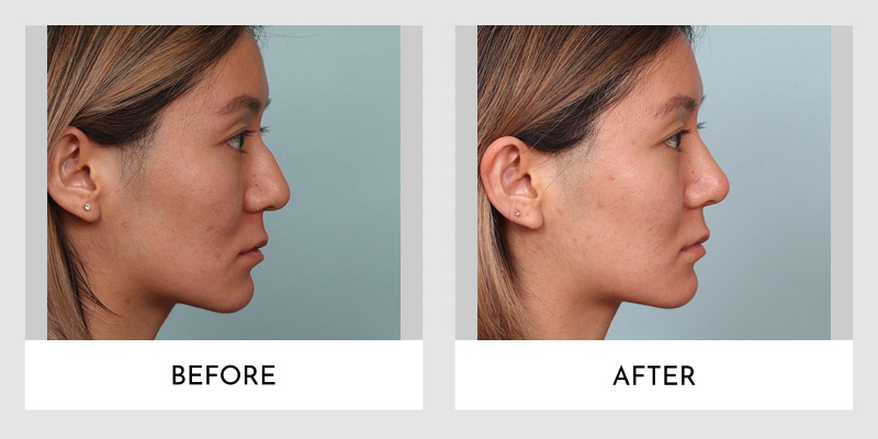 Rhinoplasty Before and After | Aesthetic MdR