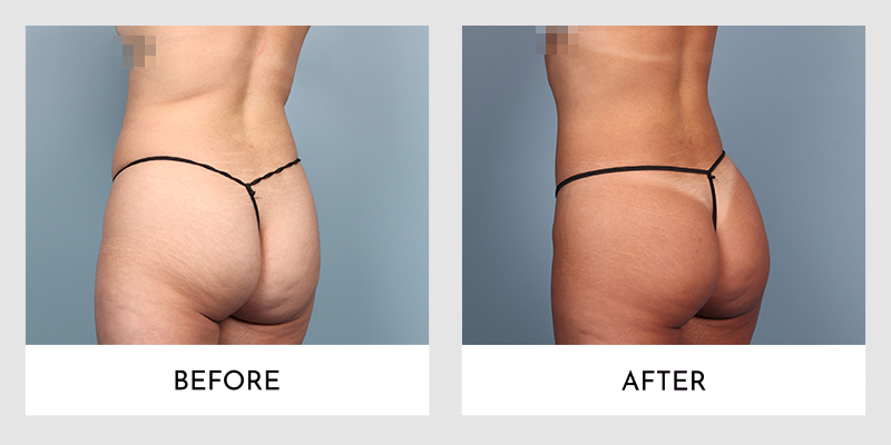 hatch Perfect Laws and regulations Skinny Brazilian Butt Lift Before and After 01 | Aesthetic MdR