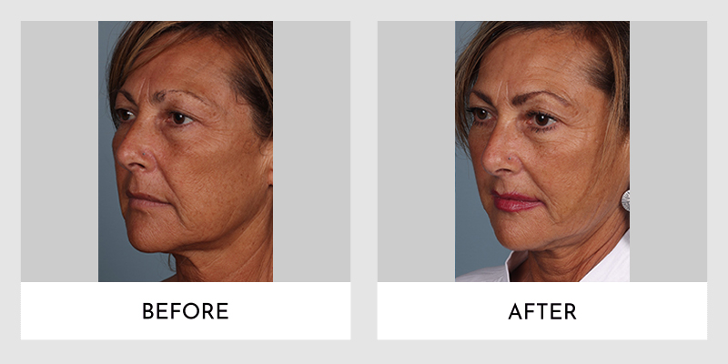 Thread Lift Before and After | Aesthetic MdR