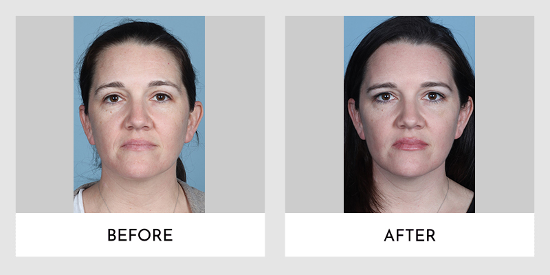 Wrinkle Reducers Before and After | Aesthetic MdR