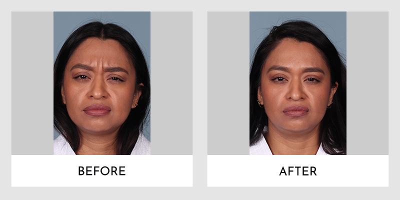 Wrinkle Reducers Before and After | Aesthetic MdR