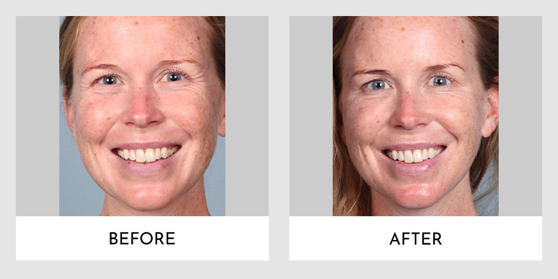 Wrinkle Reducers Before and After | Aesthetic MdR