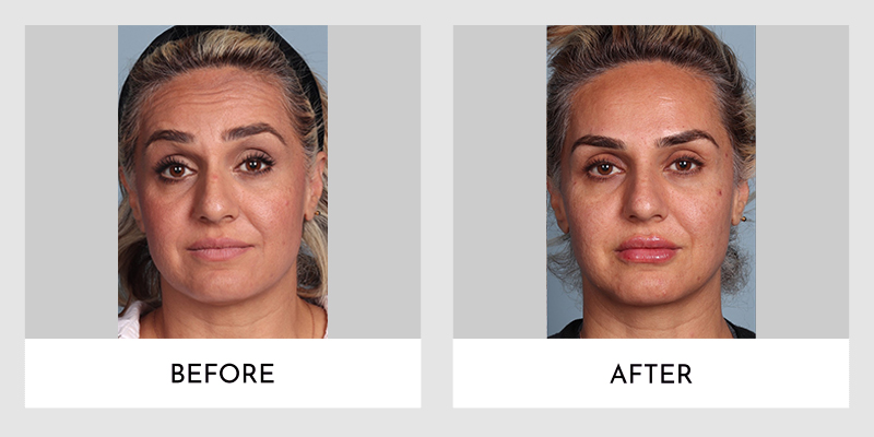 Wrinkle Reducers Before and After | Aesthetic MdR