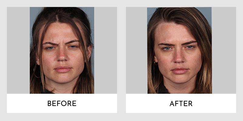 Wrinkle Reducers Before and After | Aesthetic MdR