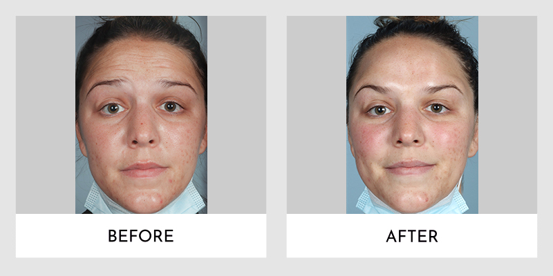 Wrinkle Reducers Before and After | Aesthetic MdR