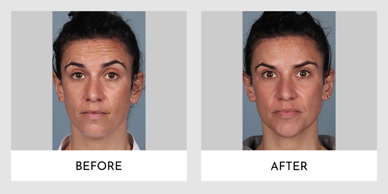 Wrinkle Reducers Before and After | Aesthetic MdR