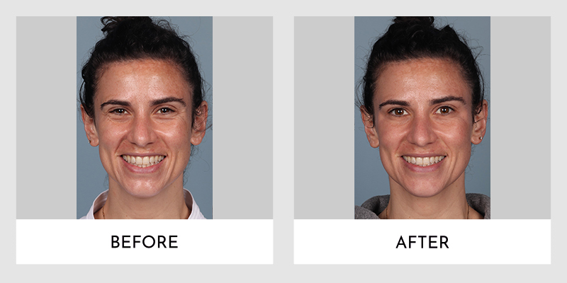 Wrinkle Reducers Before and After | Aesthetic MdR