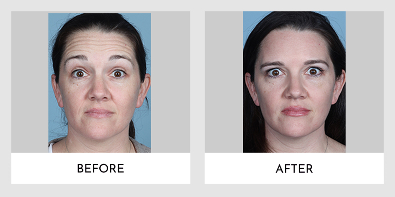Wrinkle Reducers Before and After | Aesthetic MdR