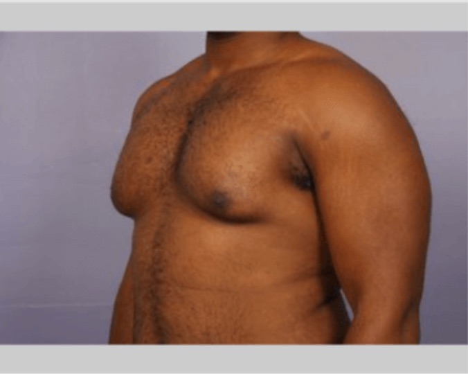 Male Breast Reduction Marina Del Rey