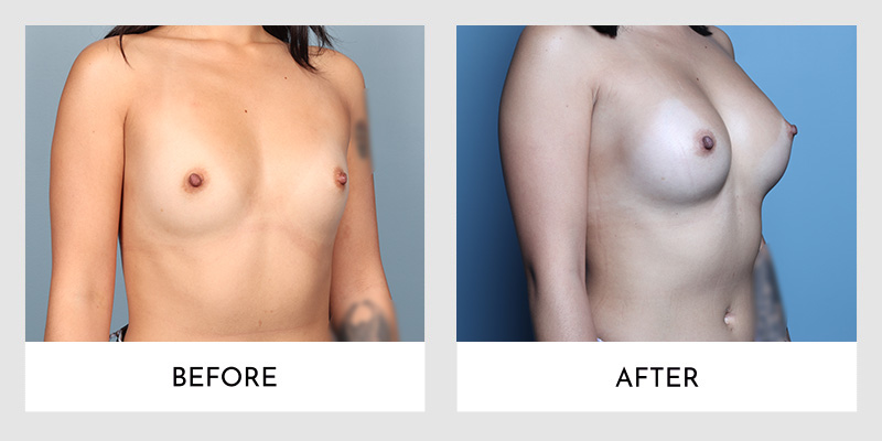 Scarless breast augmentation before and after angled view with no visible scars