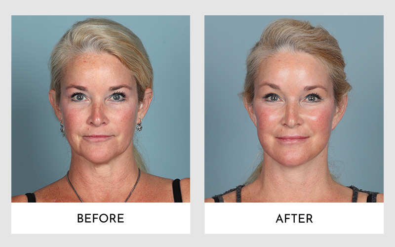 Before and after facelift results on a blonde woman.
