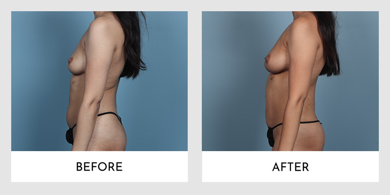 Side profile comparison showing changes in breast profile, with a more pronounced curve in the after photo.