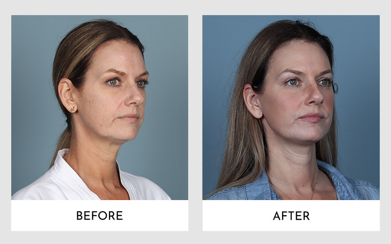  Three-quarter view facelift comparison of a brunette woman.