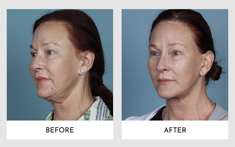  Side profile comparison showcasing results of Secondary Facelift Surgery on a woman.