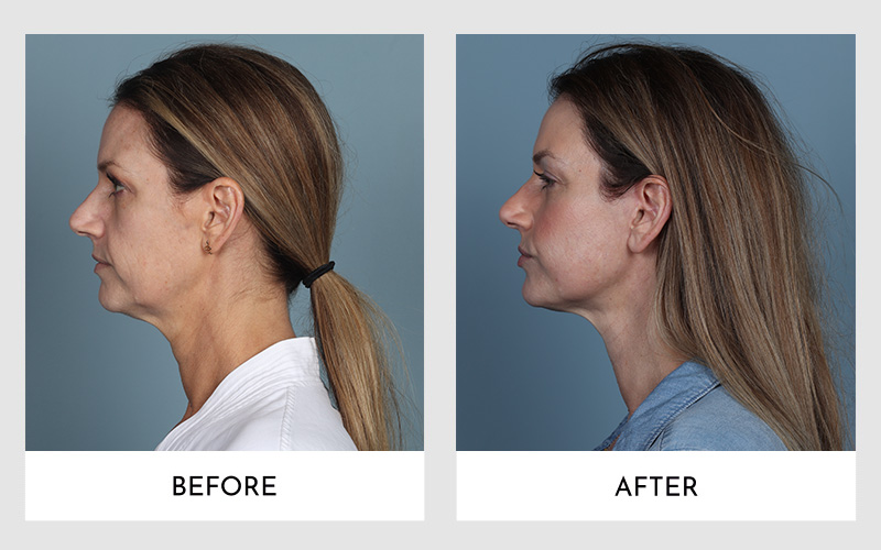 Profile comparison of a facelift on a woman with light brown hair.
