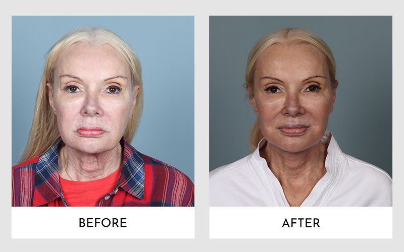 Frontal before and after photos of a woman rejuvenated by Secondary Facelift Surgery.