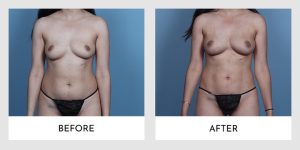 Before and after photos of a woman who underwent Fat Transfer Breast Augmentation, with noticeable fullness in the after image.