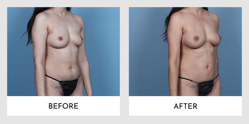 Frontal view before and after photos of Fat Transfer Breast Augmentation, illustrating frontal fullness and natural enhancement.