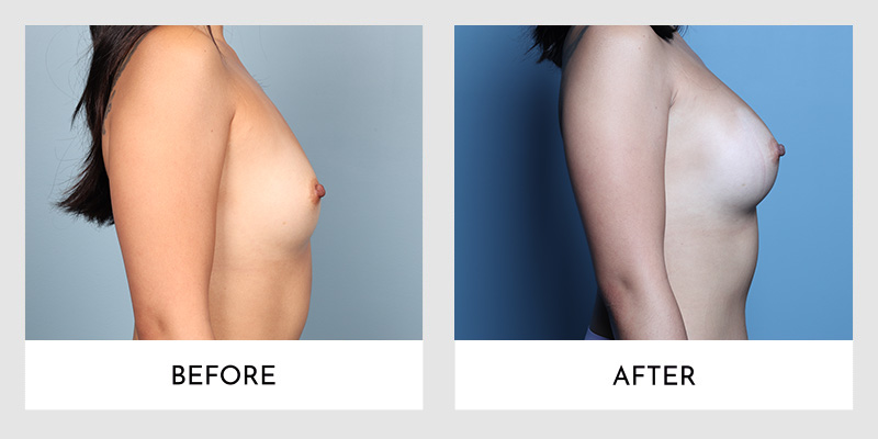 Profile view of scarless breast augmentation showing before and after comparison