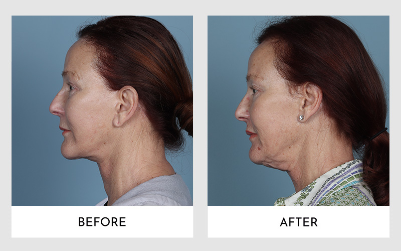 Side profile before-and-after views of a woman post-Secondary Facelift Surgery.