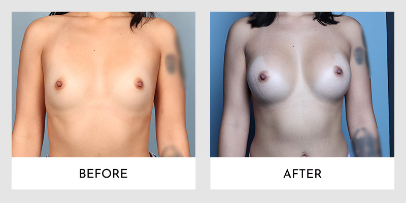 Scarless breast augmentation technique showcasing before and after results